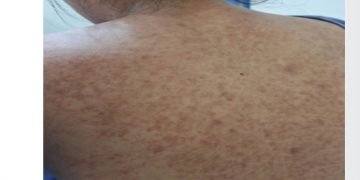 Sedes Santa Cruz declara alerta roja sanitaria por brote de sarampión