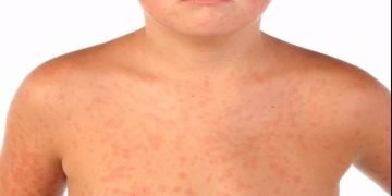 OPS insta a los países de las Américas a actuar tras la pérdida del estatus de región libre de sarampión